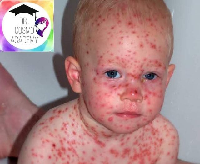 شخصي حبيب منديل  Chickenpox جدري الماء مرض يؤدي إلى ظهور طفح جلدي - مختلف للتعليم